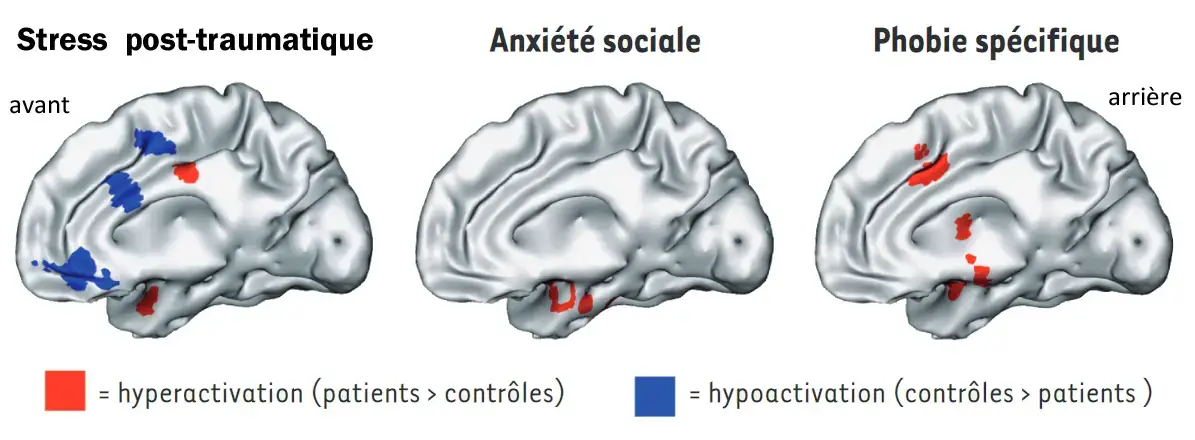 effets du syndrome post traumatique